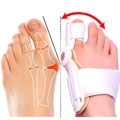 Corretor de Joanete Articulado Para Dia e Noite Hallux
